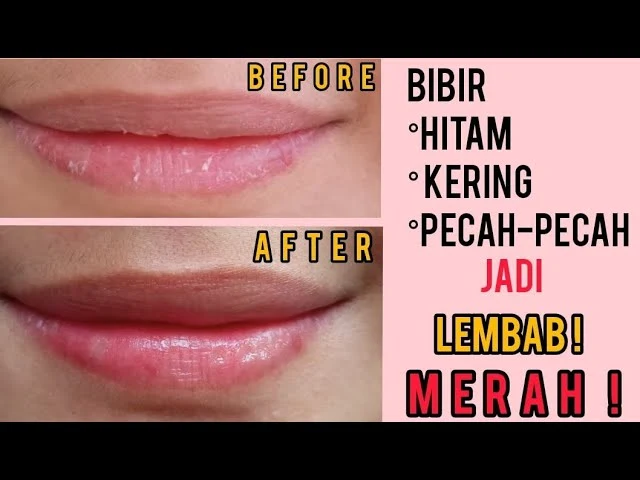 Cara mengatasi Bibir Kering