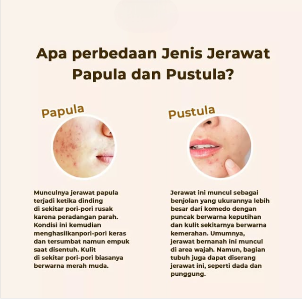 Jerawat Papula dan Pustula