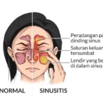 Cara Efektif Mengatasi Sinusitis