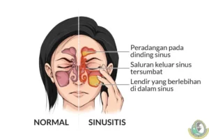 Cara Efektif Mengatasi Sinusitis