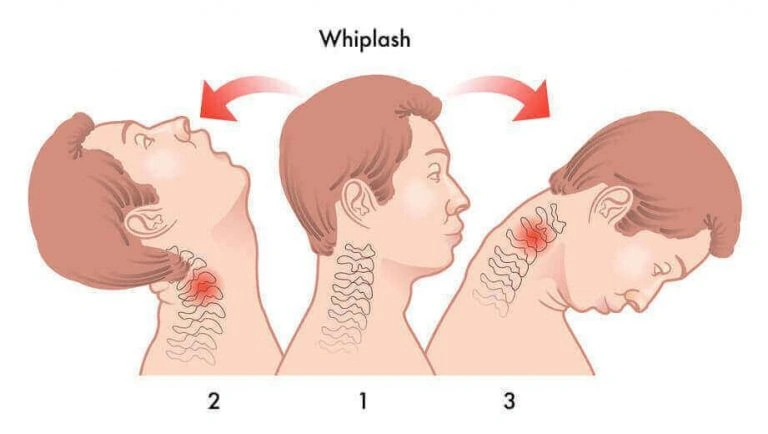 Teknik Relaksasi Mengatasi Leher Tegang