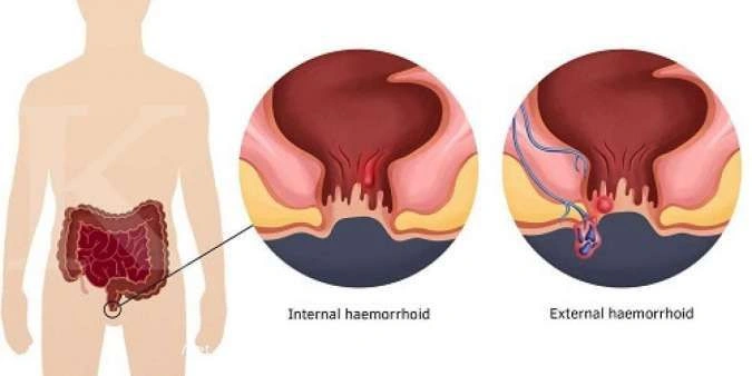 Wasir Tak Lagi Masalah! Begini Cara Efektif Mengobatinya!