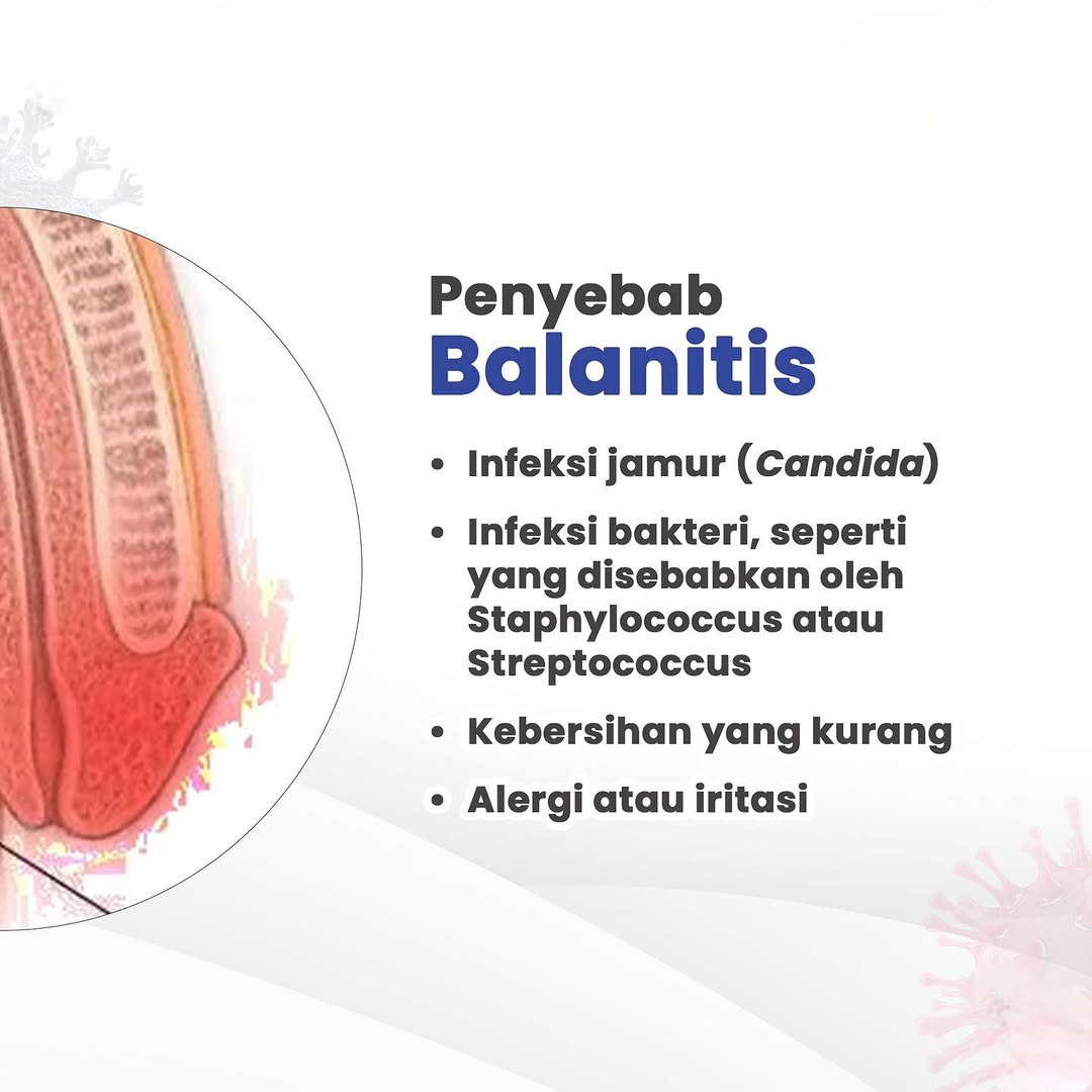 Penyebab Balanitis